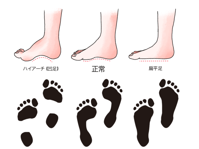 ハイアーチと偏平足の図と足跡